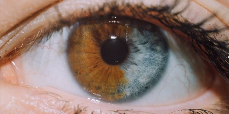 Çift Renkli Gözlerin Kaynağı Heterokromiye Dair Tüm Detaylar